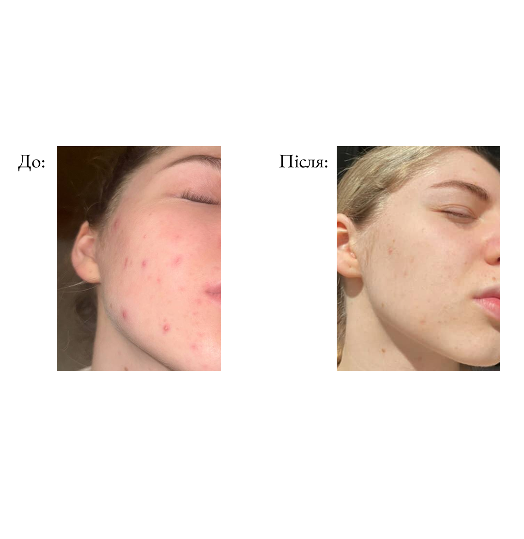 Персональний skincare аудит з лікарем-косметологом (розбір косметички|підбір догляду)-thumbmail-5